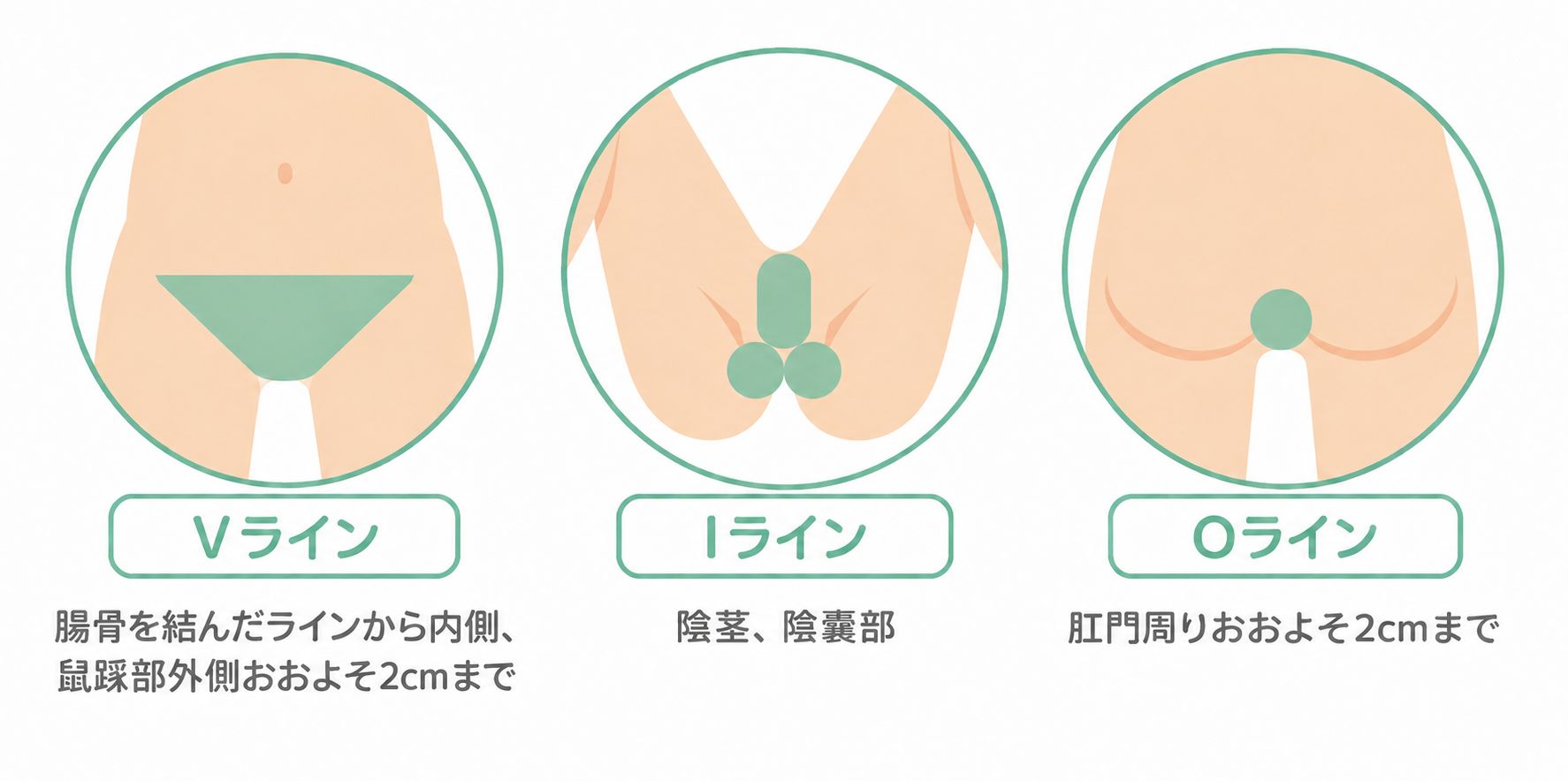 VIO脱毛施術可能部位